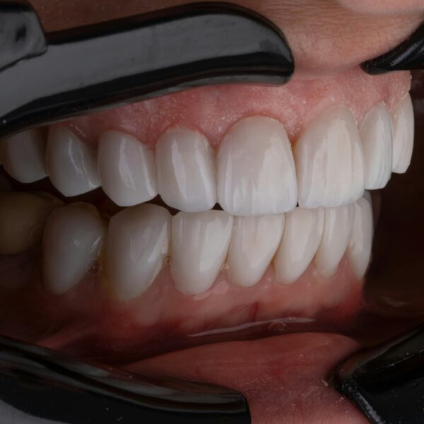 Prótesis Dentales Fijas Y Removibles